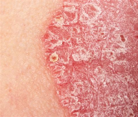 Immagine di placche psoriasiche su gomito