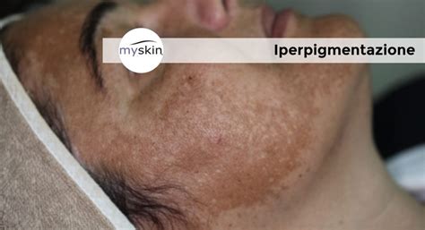 Iperpigmentazione cutanea in paziente con Malattia di Addison