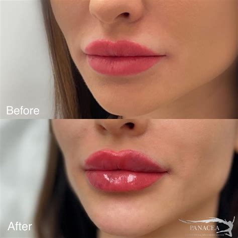 Prima e dopo trattamento filler labbra