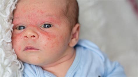 pelle di neonato irritata