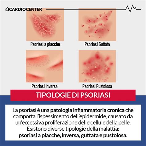 Diagramma che illustra la rapida proliferazione delle cellule cutanee nella psoriasi