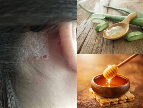 Infografica che confronta i rimedi naturali per la psoriasi
