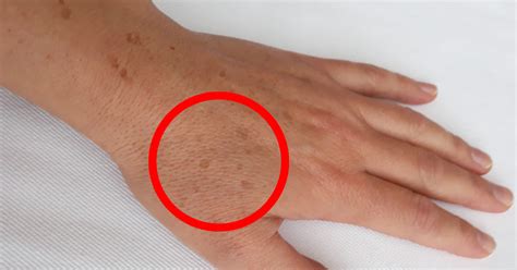 Macchie senili sul dorso delle mani