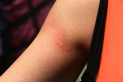 Pelle con pomfi rossi dopo puntura di medusa