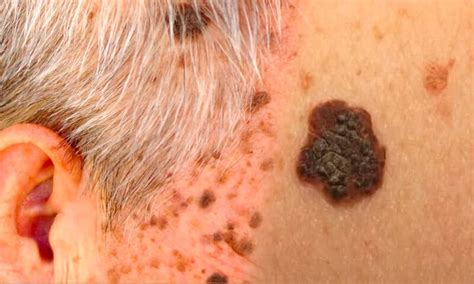 Confronto visivo tra cheratosi seborroica e melanoma