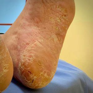 Piede affetto da psoriasi plantare con chiazze squamose e arrossate