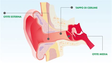 Infografica che illustra i sintomi comuni delle diverse forme di otite