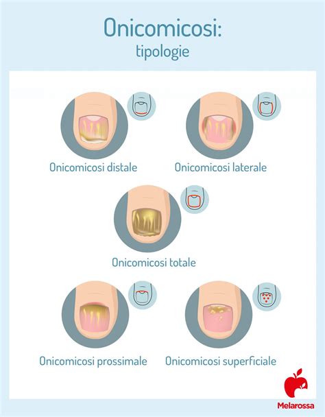 Illustrazione delle diverse tipologie di onicomicosi: distale, prossimale, superficiale bianca