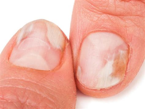 Illustrazione di unghie sane contrapposte a unghie infette da micosi