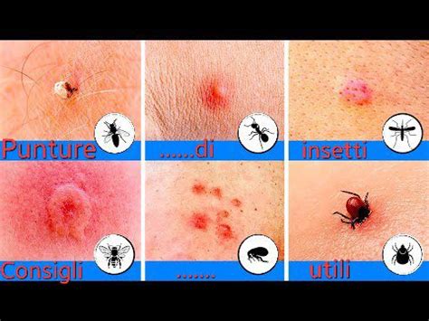 Illustrazione di diverse punture di insetti con segni visibili come gonfiore e arrossamento.