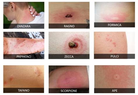 Ingrandimento di una puntura di zanzara sulla pelle.