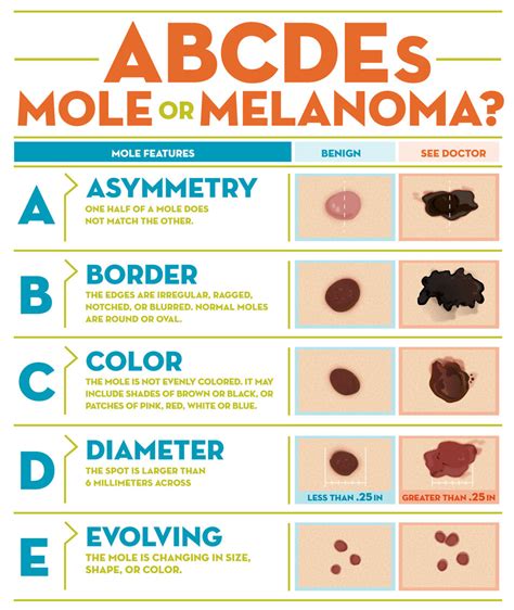 schema riassuntivo dei criteri ABCDE del melanoma