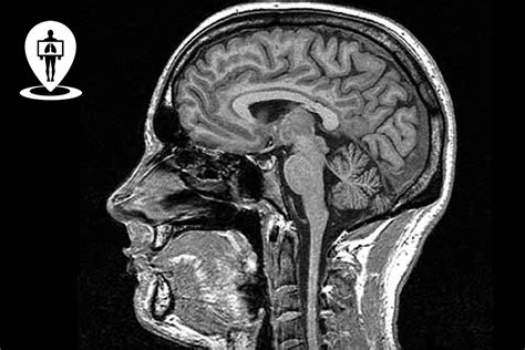 Immagine di una risonanza magnetica cerebrale che mostra una lesione nella regione parietale.