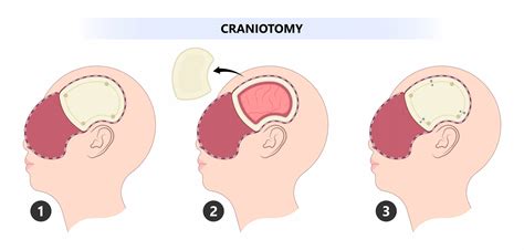 Diagramma che illustra le diverse fasi di una craniotomia, dalla incisione cutanea alla rimozione dell'opercolo osseo.
