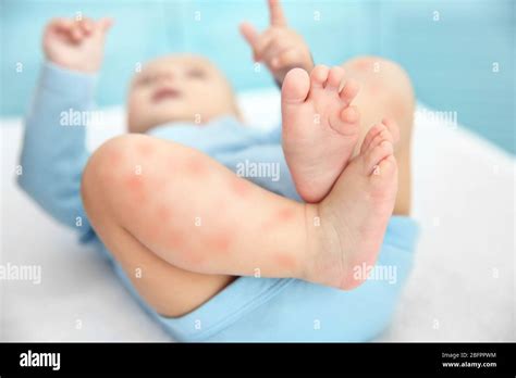 bambino con eruzione cutanea