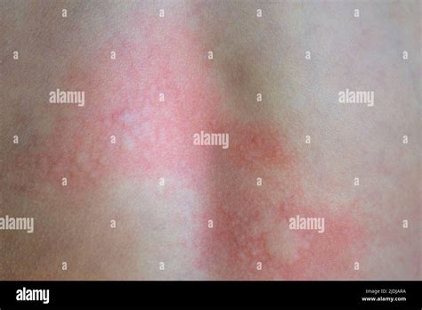 Manifestazione di orticaria sulla pelle