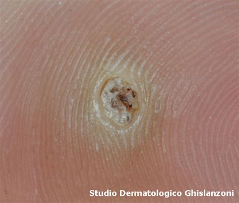 Immagine dettagliata di una verruca plantare con puntini neri