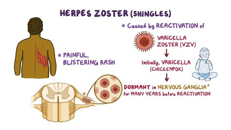 Scheda riassuntiva: Protezione solare dopo Herpes Zoster