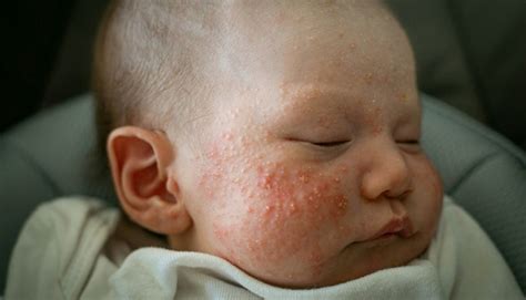 Neonato con acne neonatale