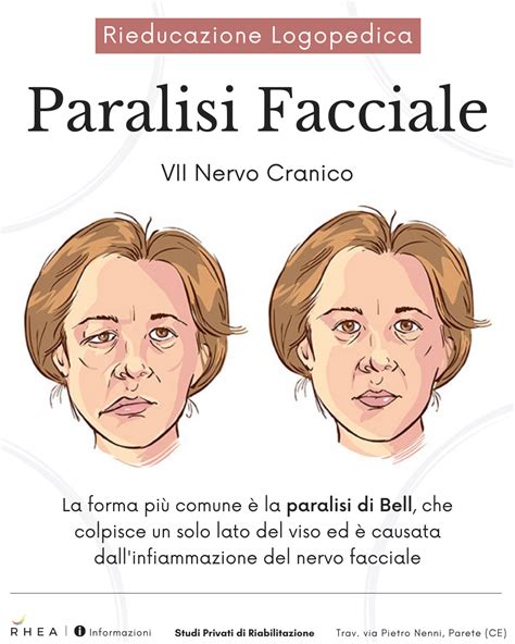 Illustrazione di una paralisi facciale
