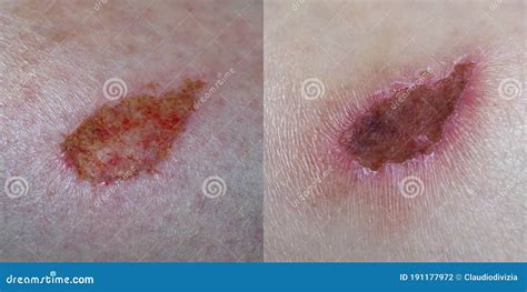 Tessuto cicatriziale ipertrofico