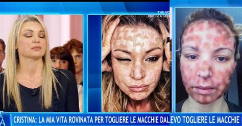 Laser per il trattamento delle cicatrici