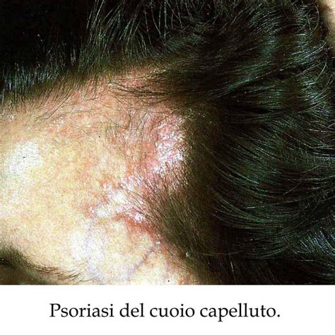 Bambino con chiazze di alopecia sul cuoio capelluto