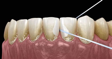 Illustrazione di una placca psoriasica sull'orecchio