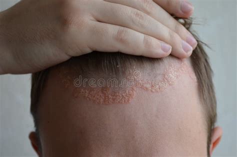 Primo piano di un cuoio capelluto sano e pulito
