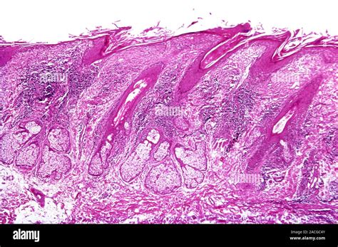 Immagine microscopica di pelle affetta da paracheratosi