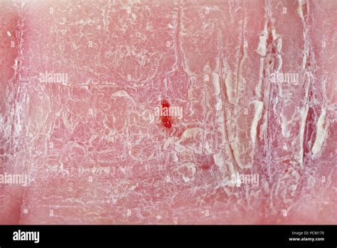 Pelle secca e screpolata