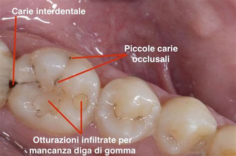 Dente con puntino nero