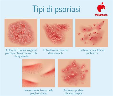 Manifestazioni cutanee della psoriasi