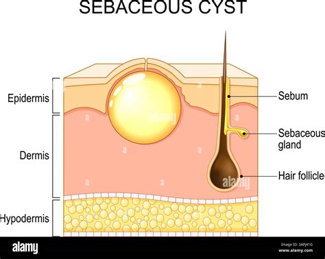 Schematic representation of a sebaceous cyst under the skin