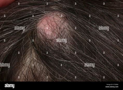 Close-up of a sebaceous cyst on the scalp