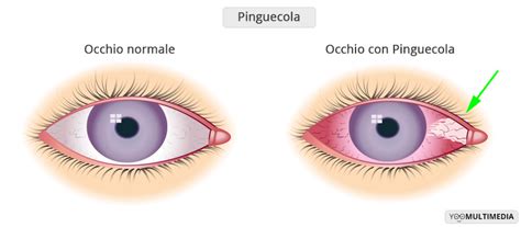 Occhio con pinguecola visibile sulla sclera bianca