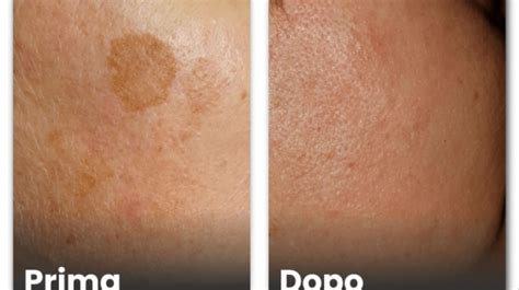 Immagine comparativa di diverse tipologie di macchie cutanee: lentiggini solari, melasma e iperpigmentazione post-infiammatoria