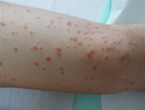 Immagine di pelle con psoriasi guttata