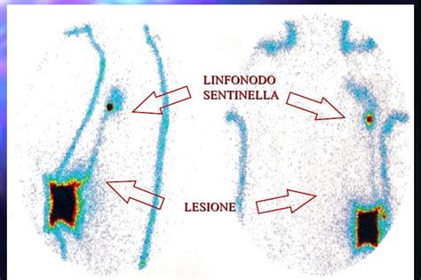 Illustrazione schematica della procedura di linfoscintigrafia e biopsia del linfonodo sentinella