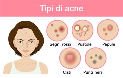 Schema dei diversi tipi di brufoli