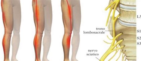 Diagramma del nervo sciatico e delle sue ramificazioni