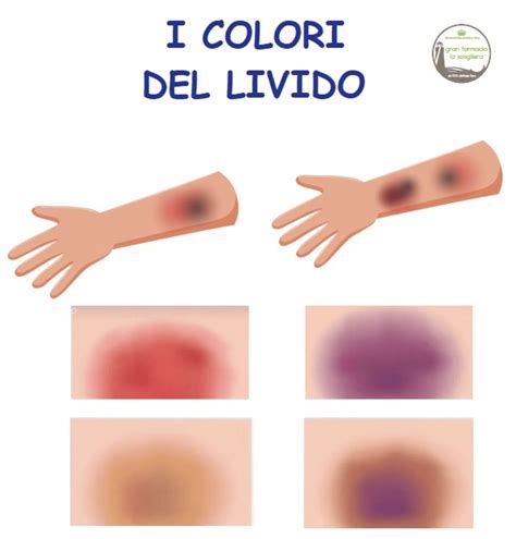 Rappresentazione schematica di un livido che si forma dopo un trauma