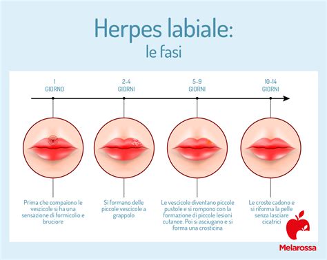 Immagine di un episodio di herpes labiale in diverse fasi