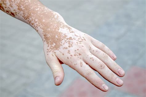 Confronto visivo tra le lesioni della vitiligine e della psoriasi