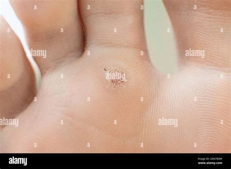 Primo piano di una verruca comune su un dito