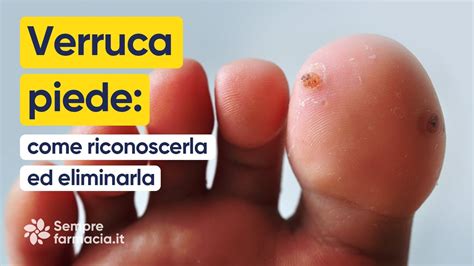 Immagine di una verruca che ha assunto un colore nero, indicando il processo di necrosi