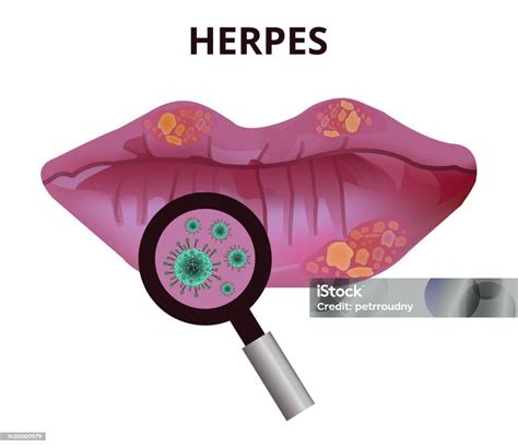 Illustration of blisters on the lips, a common symptom of herpes simplex