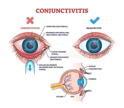 Occhio congiuntivite