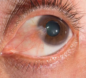 Cornea infiammata