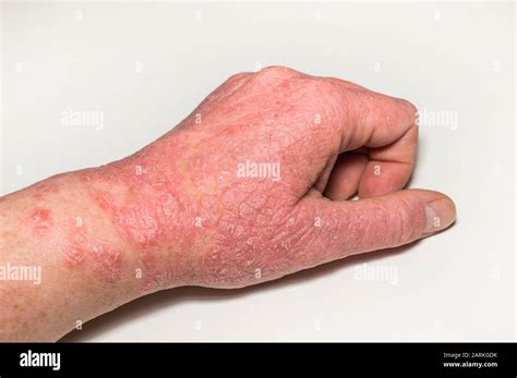 pelle infiammata della mano con eczema